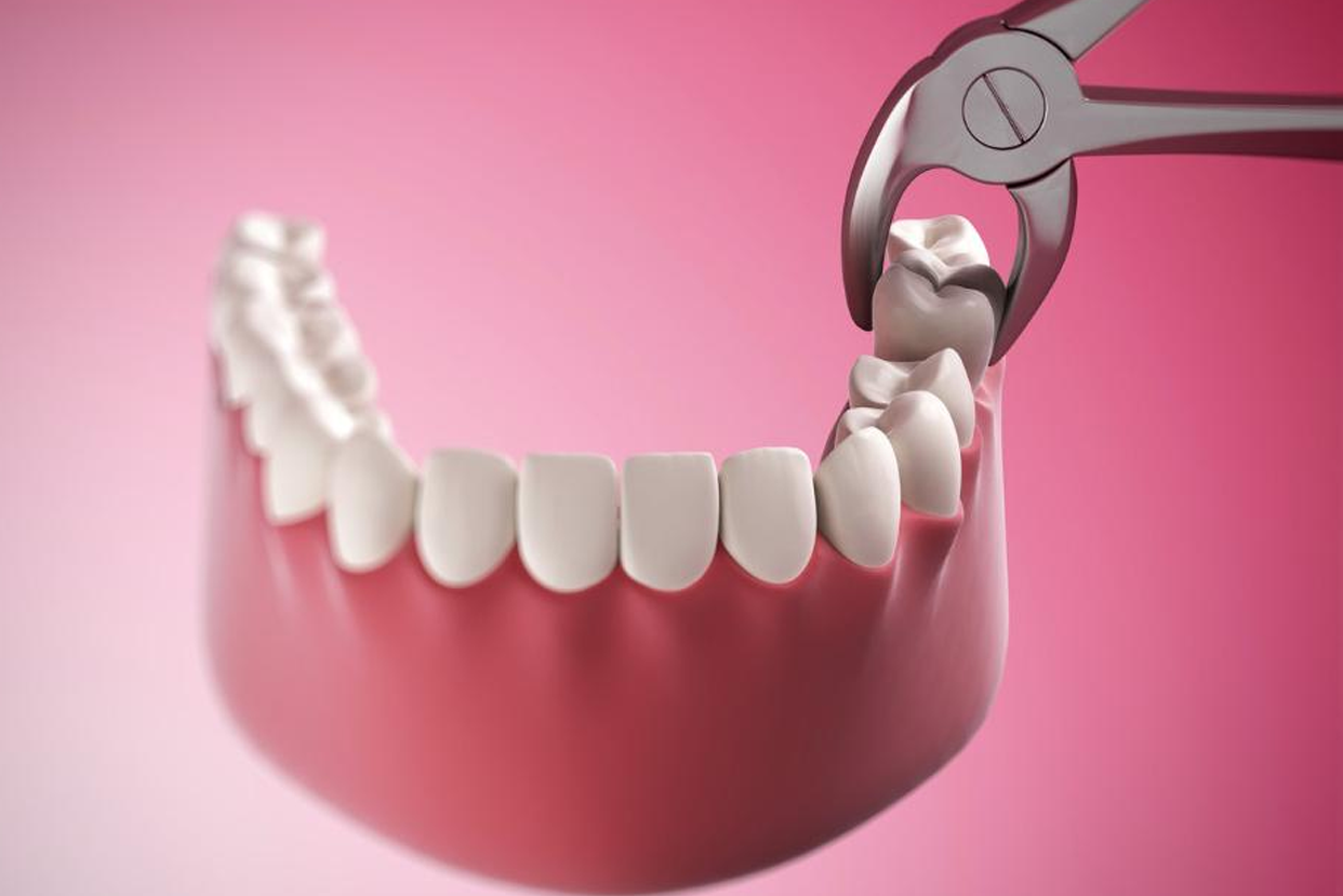 Wisdom Tooth Impaction - Ojas Dental Clinic