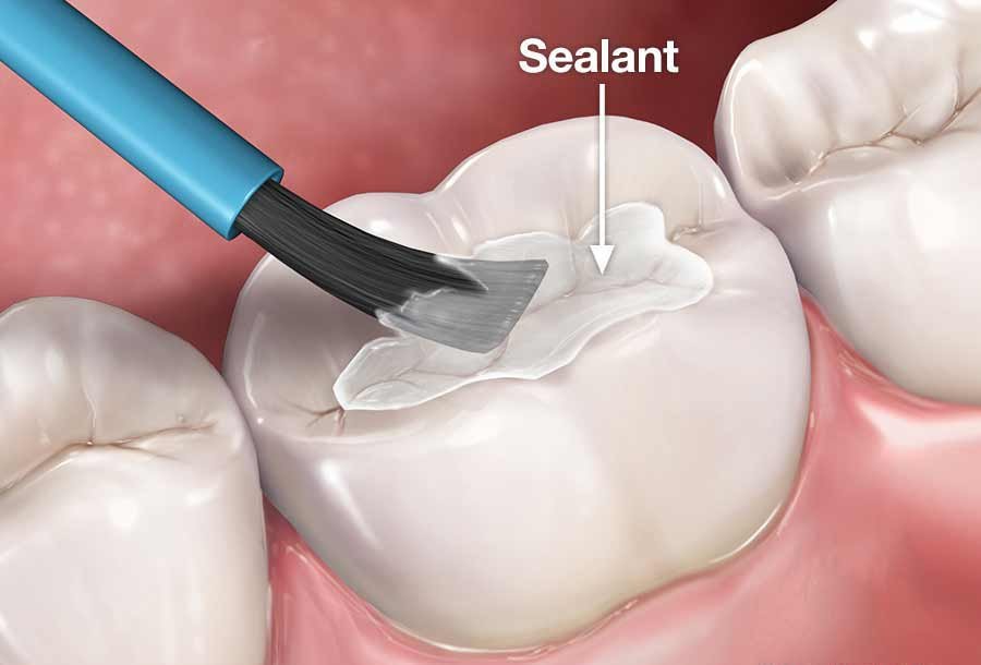 Who Should Get Pit and Fissure Sealants - Ojas Dental Clinic