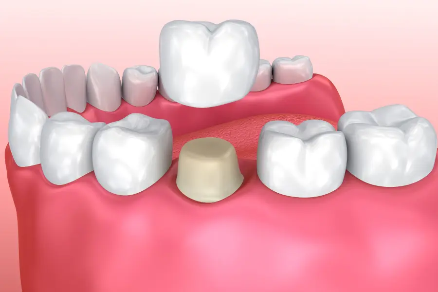 Tabletop Crown - Ojas Dental Clinic