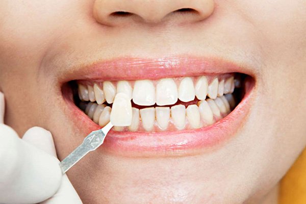 Who Is a Candidate for Laminates / Veneers - Ojas Dental Clinic