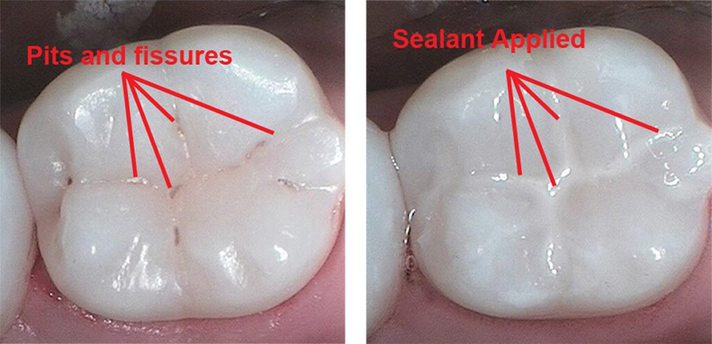 Pit and Fissure Sealants