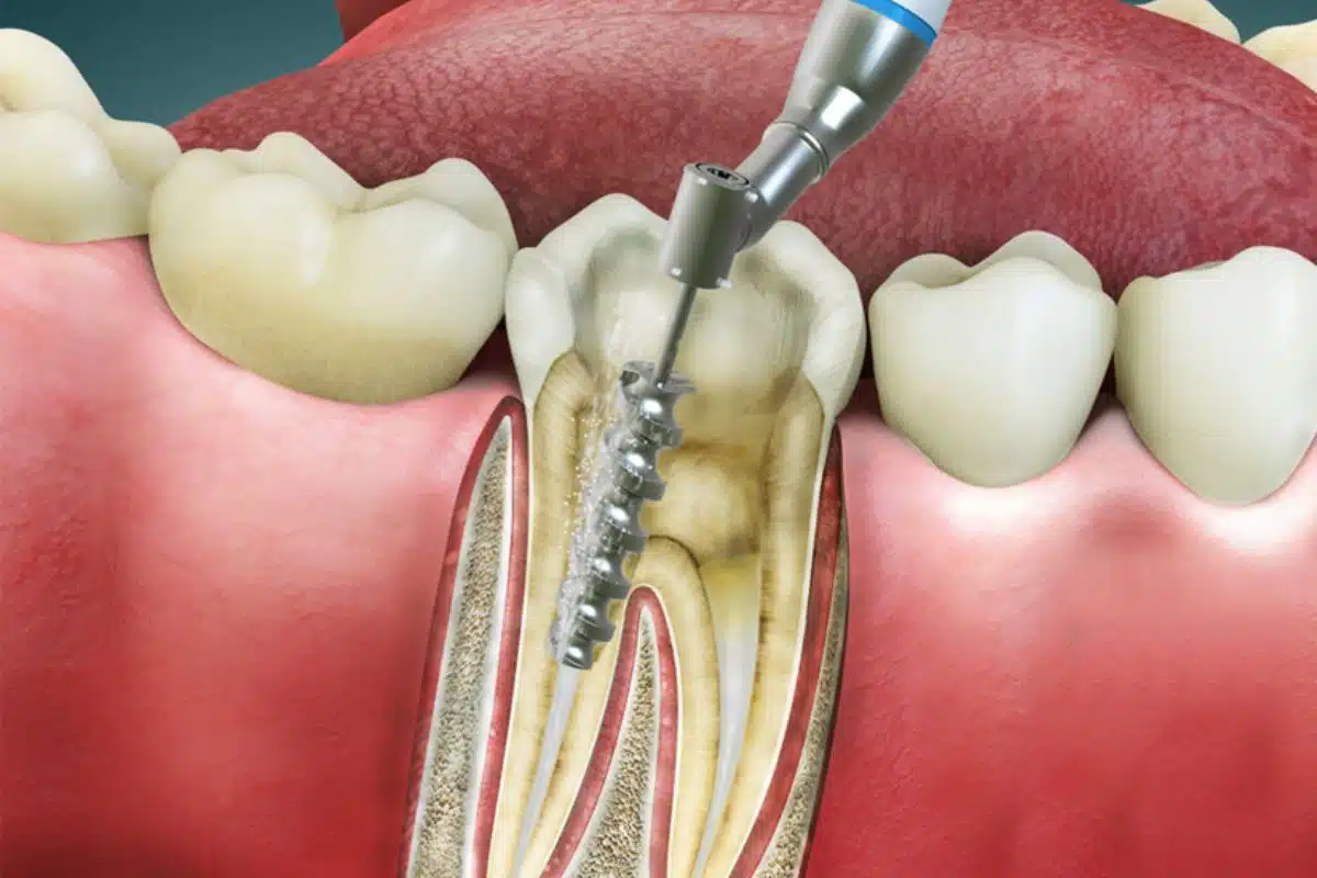 Root Canal