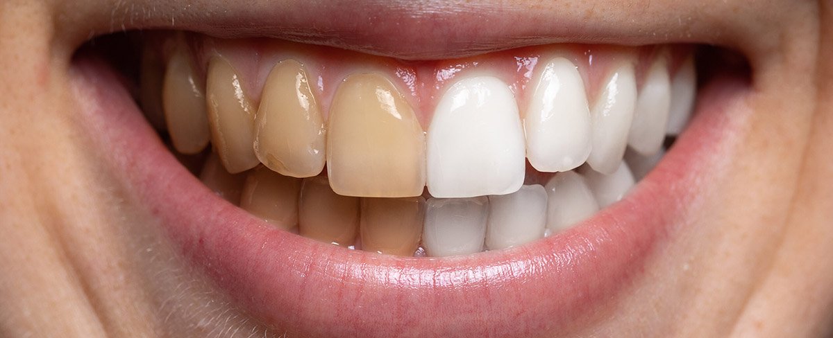 Whitening Confidence - Ojas Dental Clinic