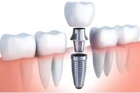 Dental Implant Structure - Ojas Dental Clinic