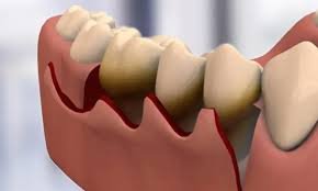 Gum Flap Surgery - Ojas Dental Clinic