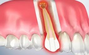 Apicectomy Procedure - Ojas Dental Clinic