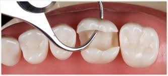 Tooth Cavity Check - Ojas Dental Clinic