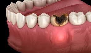 Dental Abscess Treatment - Ojas Dental Clinic